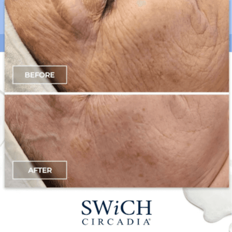 SWiCH 6 Treatment Package at MUSE Beauty Lounge in Taylor, TX